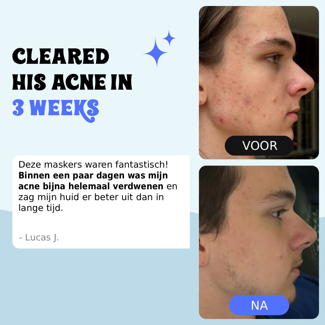 Behandeling voor Tieneracne & Herstelt de Buid